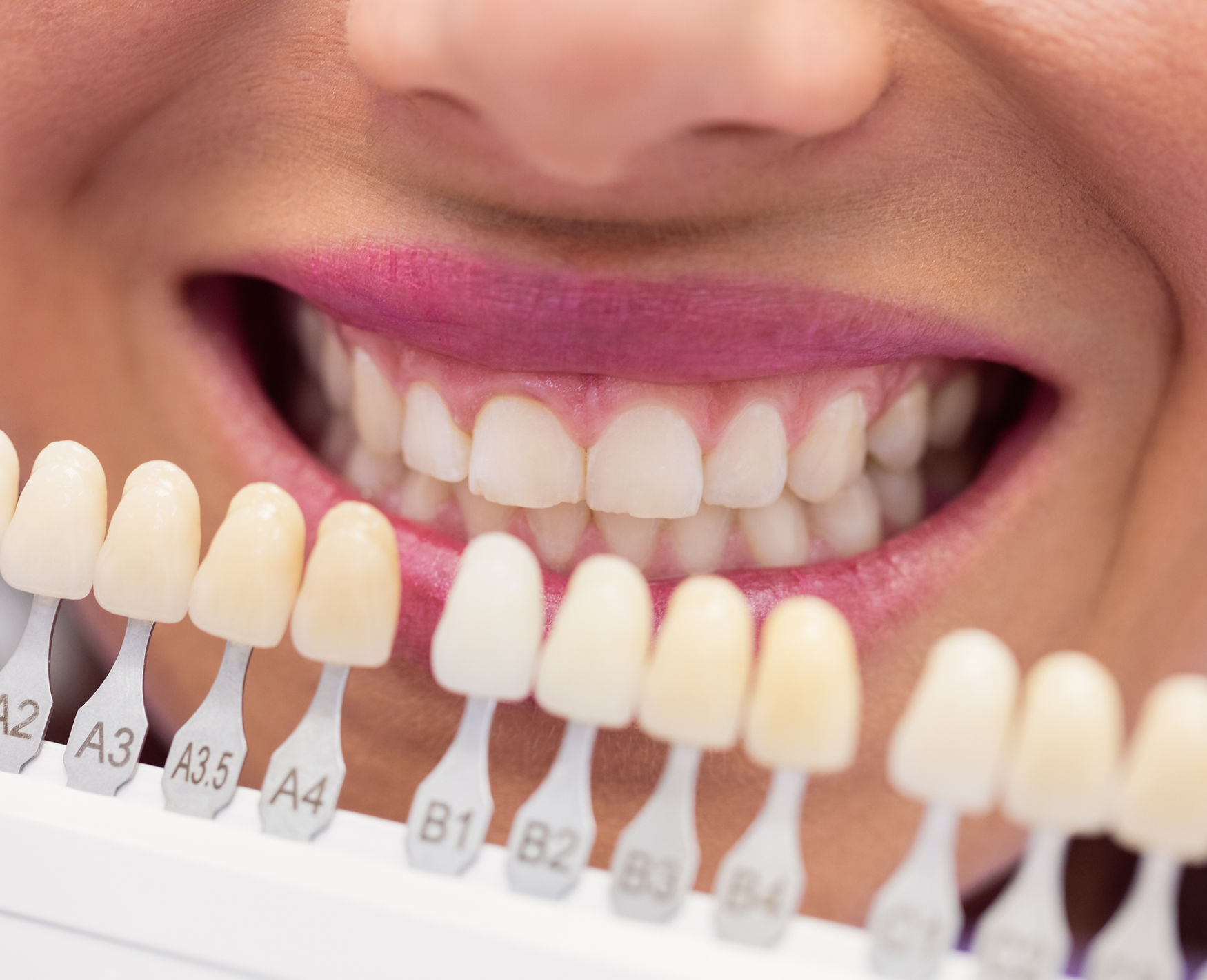 Composite bonding and veneers