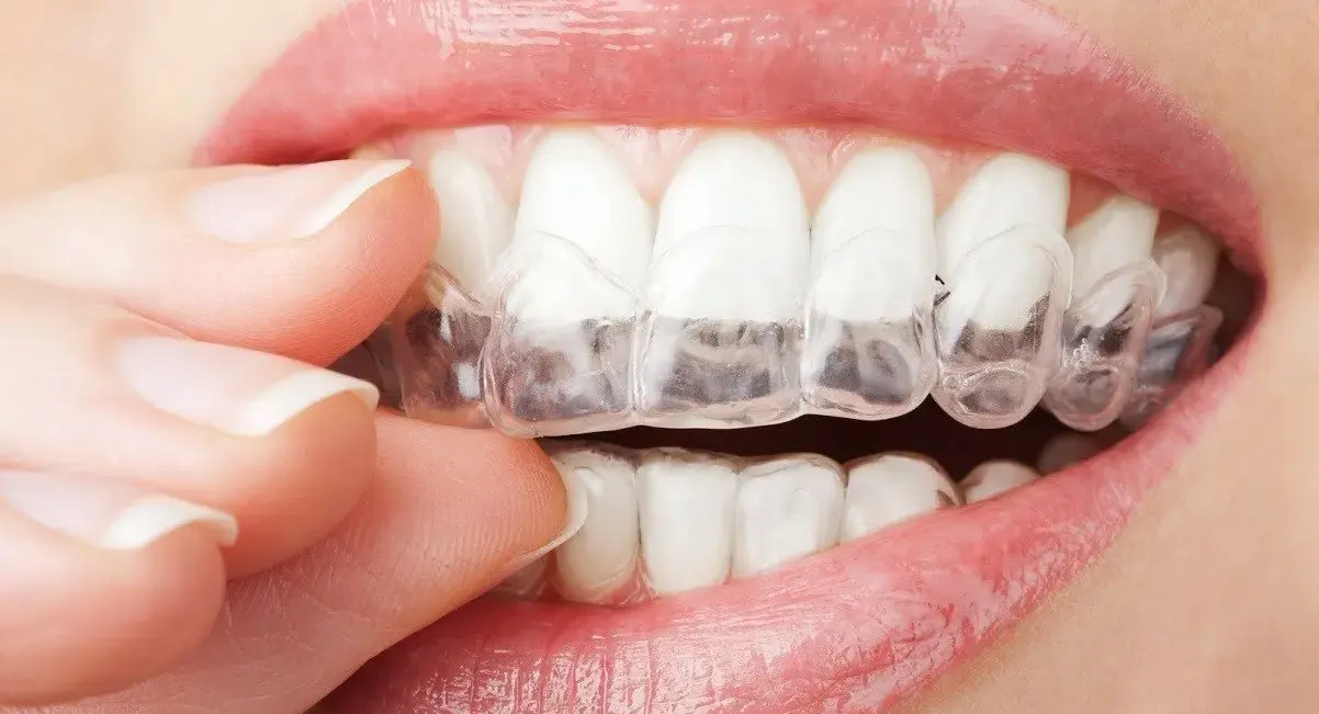 AddaSmile clear aligners