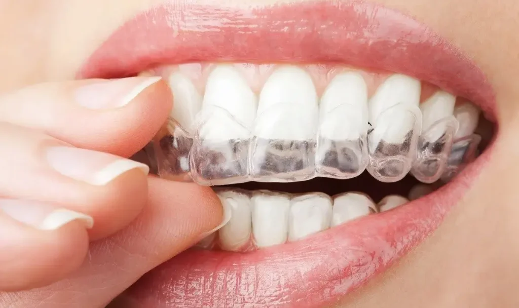 Invisalign Teen Chelsea