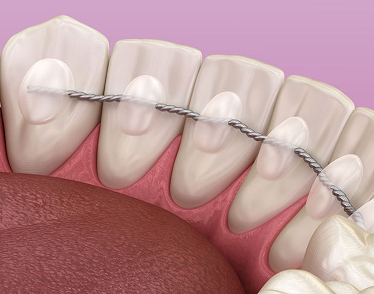 Fixed braces in Chelsea